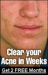 Top Acne Treatment : Acnezine
